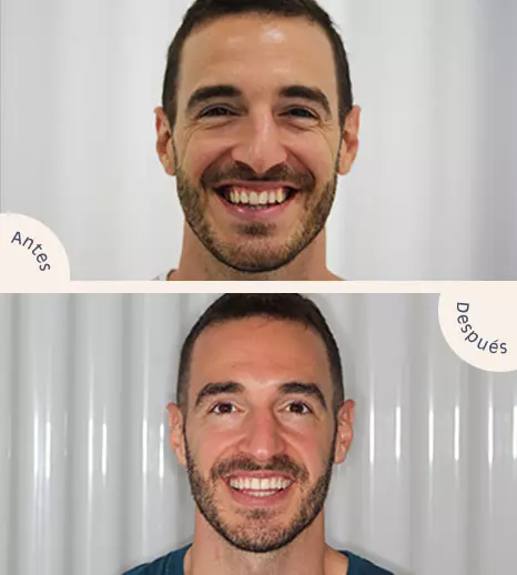 Resultados Antes y Después Ortodoncia Invisible
